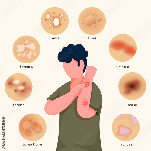 Faceless Young Boy Itching His Hands and Showing Different Skin Rashes on Background.