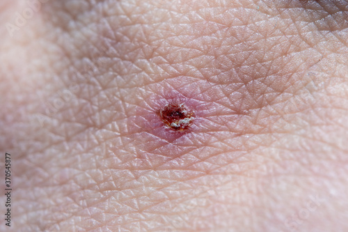 A close-up of a dried wound on human skin. A part of a man's leg with a wound that has healed after injury.