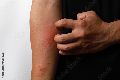 Close up dermatitis on the skin, ill allergic rash dermatitis eczema skin of a patient, atopic dermatitis symptom skin detail texture. Fungus of human skin. photo