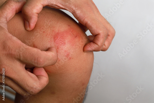 Close up dermatitis on skin  ill allergic rash dermatitis eczema skin of patient   atopic dermatitis symptom skin detail texture   Fungus of skin  The concept dermatology.