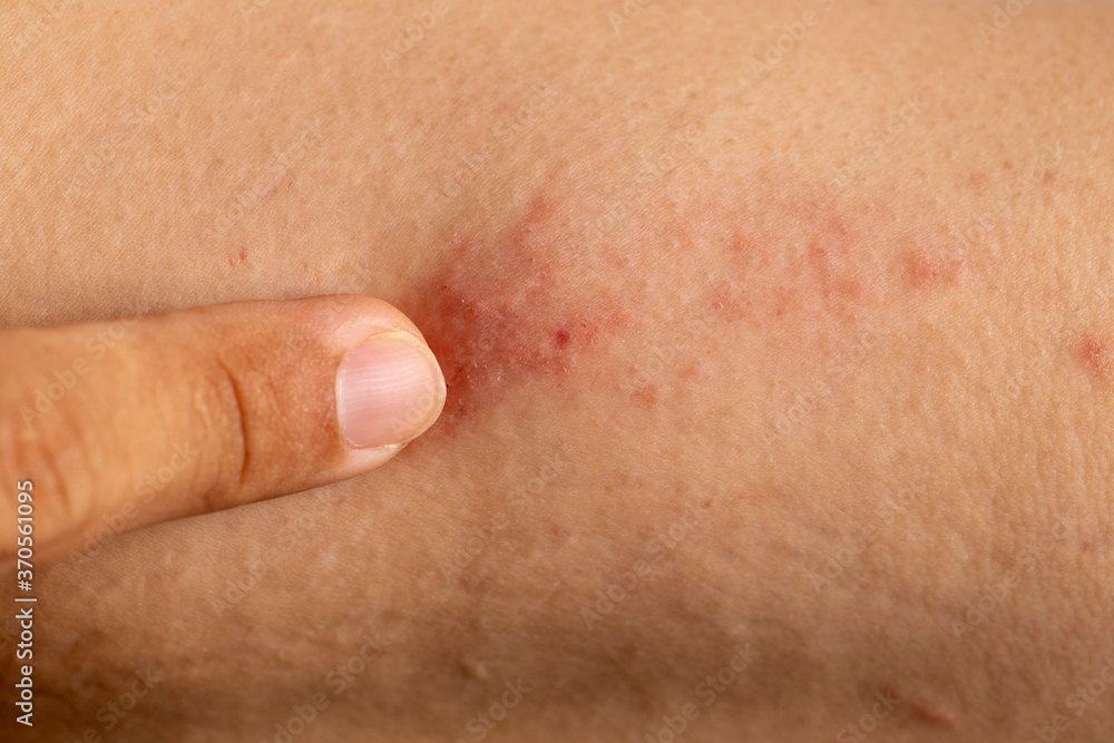 Close up dermatitis on skin, ill allergic rash dermatitis eczema skin of patient , atopic dermatitis symptom skin detail texture , Fungus of skin ,The concept dermatology. Close up dermatitis on skin, ill allergic rash dermatitis eczema skin of patient , atopic dermatitis symptom skin detail texture , Fungus of skin ,The concept dermatology.