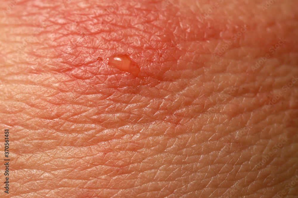 Close up dermatitis on skin, ill allergic rash dermatitis eczema skin of patient , atopic dermatitis symptom skin detail texture , Fungus of skin ,The concept dermatology. Close up dermatitis on skin, ill allergic rash dermatitis eczema skin of patient , atopic dermatitis symptom skin detail texture , Fungus of skin ,The concept dermatology.