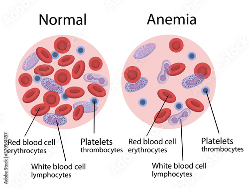 Vector illustration of anemia