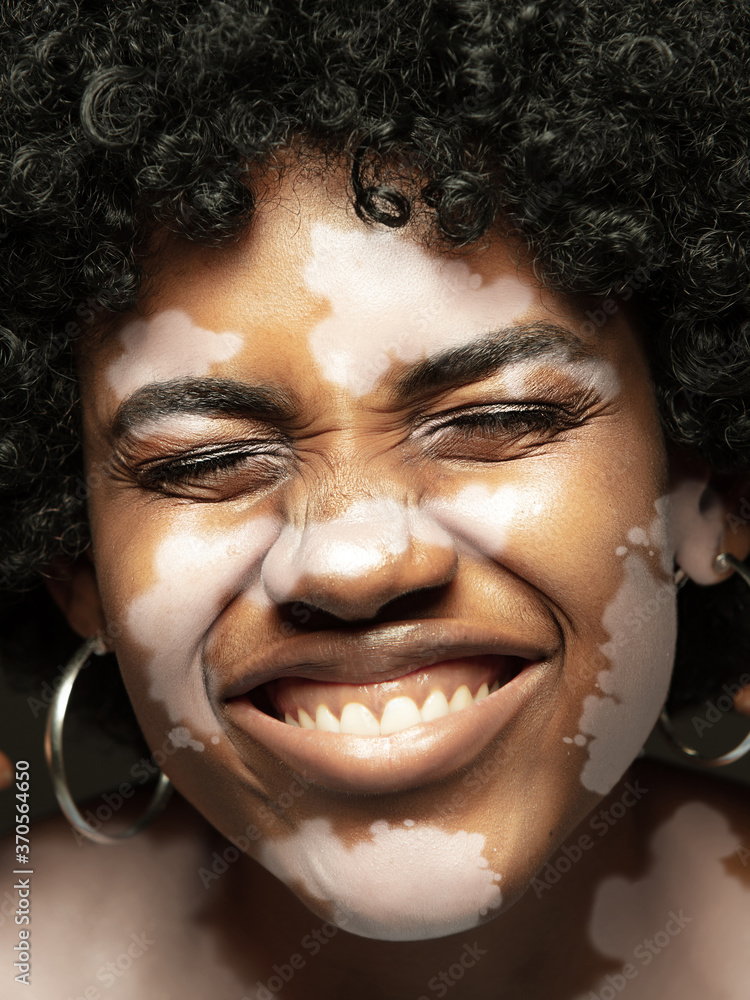 Portrait of africanamerican woman with vitiligo skin. Special skin with depigmentation because