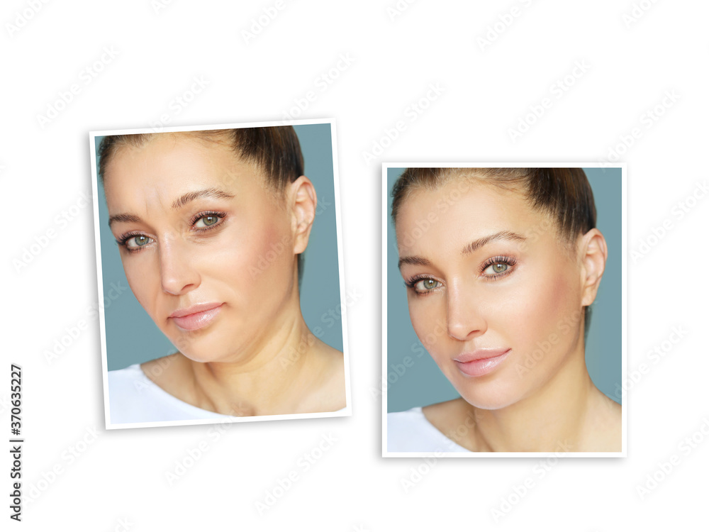 Effects of ageing,Frown/scowl lines ,Nasolabial folds,Neck ,Under eye circles,neck lines