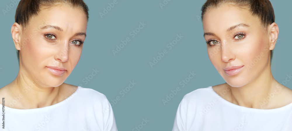 Effects of ageing,Frown/scowl lines ,Nasolabial folds,Neck ,Under eye circles,neck lines. Plastic Surgery Results Effects of ageing,Frown/scowl lines ,Nasolabial folds,Neck ,Under eye circles,neck lines. Plastic Surgery Results