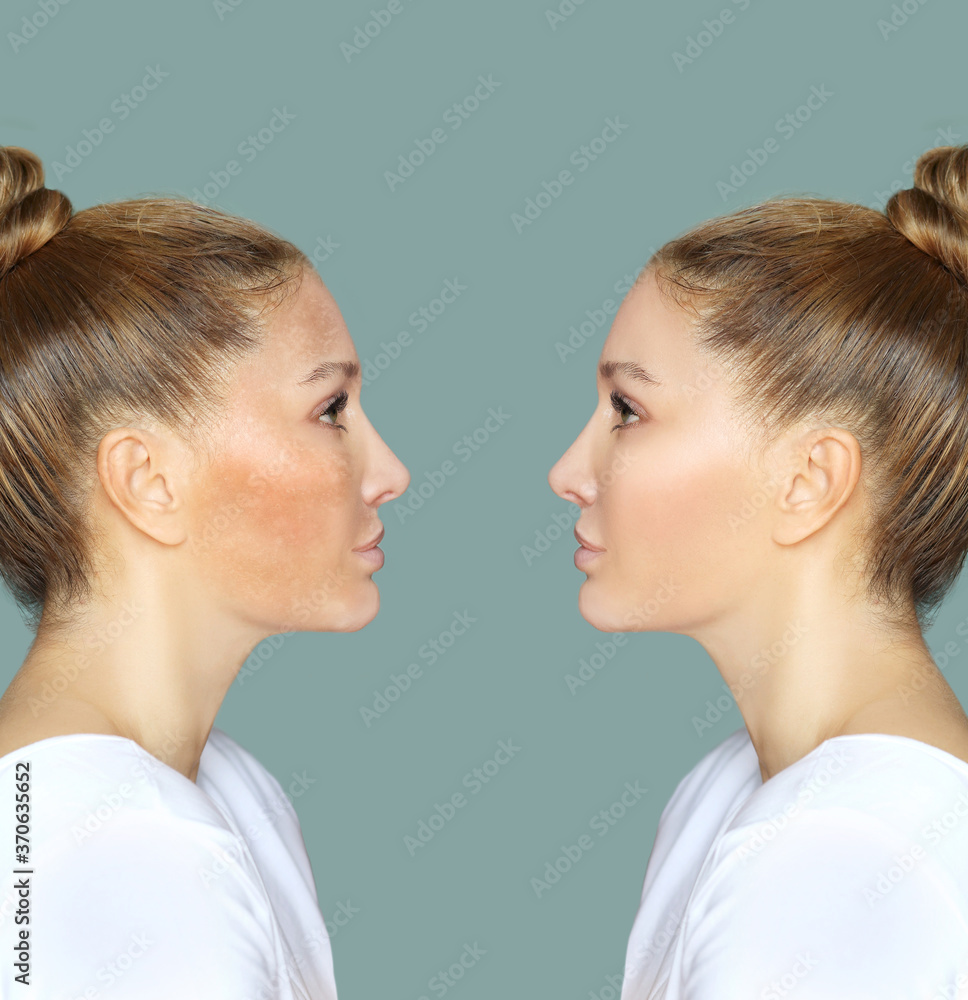 Dark spots, freckles,hyperpigmentation(melasma or chloasma) Dark spots, freckles,hyperpigmentation(melasma or chloasma)