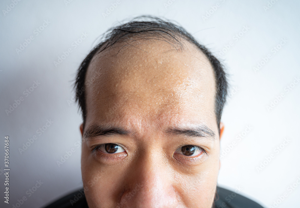 Fototapeta premium Closed portrait of Asian man with sweating on his forehead cause of hot weather or etc.