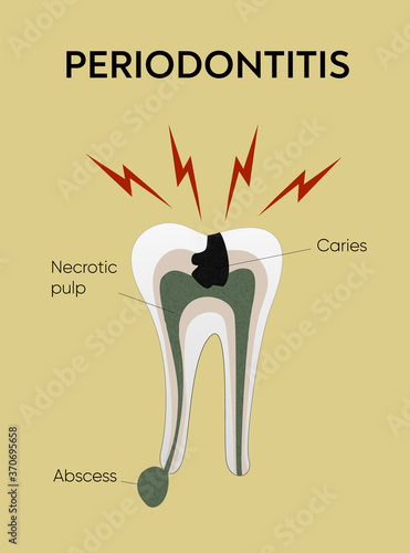 Patient education poster showing the process of caries  and periodontitis formation in the tooth and reasons causes