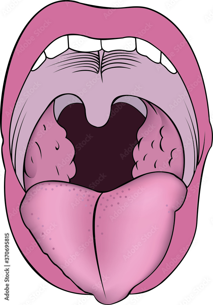 Images of adenoidsgrowth of lymphoid tissue of the nasopharyngeal