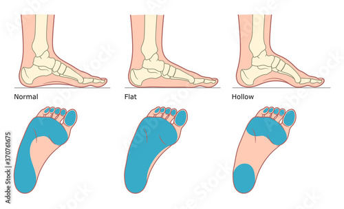 Foot deformation types illustration