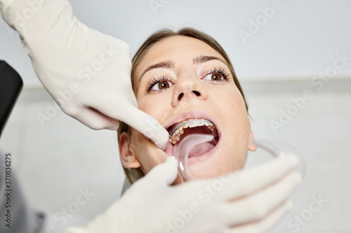 From above of crop faceless doctor placing dental retractor in mouth of female patient with braces in hospital photo