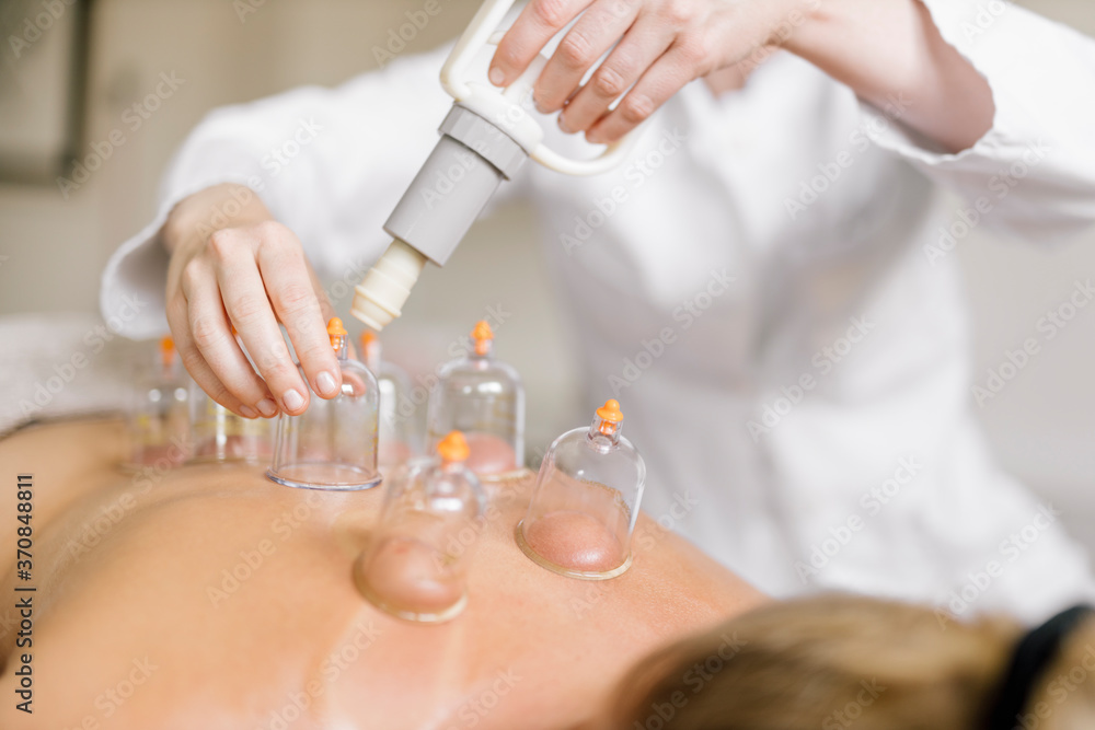 Cupping therapy, treatment at back Cupping therapy, treatment at back