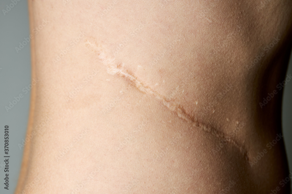 surgery scar after kidney pyelonephritis. after remove kidney operation. caucasian person close up over gray background surgery scar after kidney pyelonephritis. after remove kidney operation. caucasian person close up over gray background