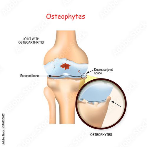 Osteophyte. Human knee joint with osteoarthritis.