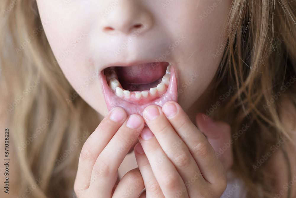 The child is growing a molar, but the milk tooth did not fall out. Problems with children's teeth. Shark bite The child is growing a molar, but the milk tooth did not fall out. Problems with children's teeth. Shark bite
