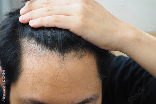 Young Asian man using his hand slicking his hair back after facing hair loss problem by taking medicine like zinc and biotin to make his hair grow faster and thicker. Men health and medical concept