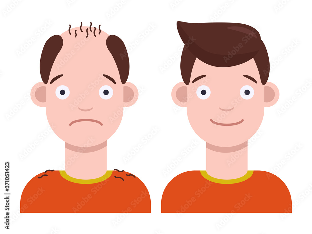 Flat vector illustration: man with bald head and man with thick hair. Hair transplant concept. Hair loss concept. Flat vector illustration: man with bald head and man with thick hair. Hair transplant concept. Hair loss concept.