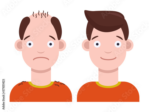 Flat vector illustration: man with bald head and man with thick hair. Hair transplant concept. Hair loss concept.