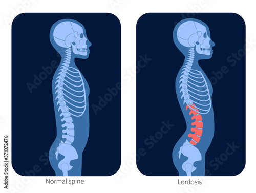 Spine X ray