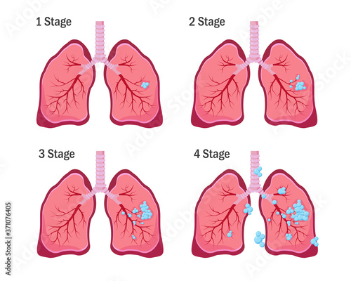 Four stages of lung cancer disease.