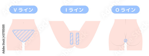 脱毛箇所　VIO　デリケートゾーン