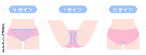 脱毛箇所　VIO　デリケートゾーン　インナー着用