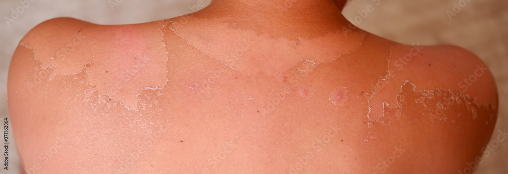 Fototapeta premium close up shot of sunburn and sunburn peeling. Close up detail of a very bad sunburn showing the peeling skin of man.