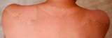 close up shot of sunburn and sunburn peeling. Close up detail of a very bad sunburn showing the peeling skin of man.