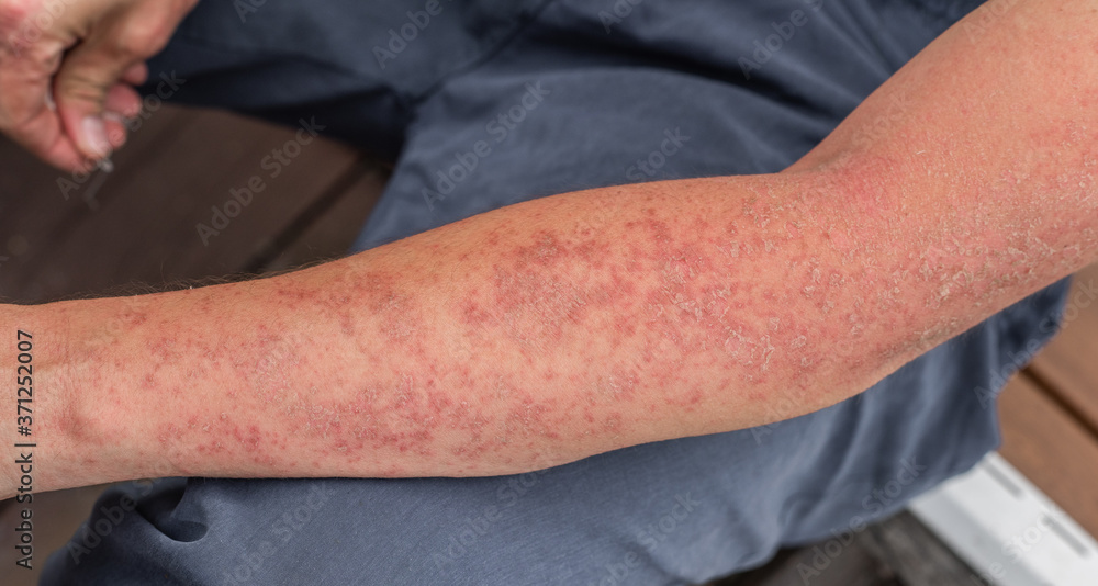 Dyshidrotic autoimmune eczema of patient. Concept of health care Stock Photo Adobe Stock