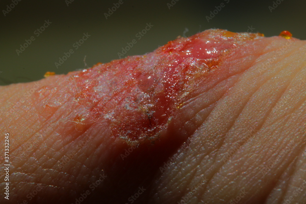 重度のアトピーに苦しむアレルギーを持つ男性の血だらけの皮膚 Tekstury Naklejki Ecowall24 Pl