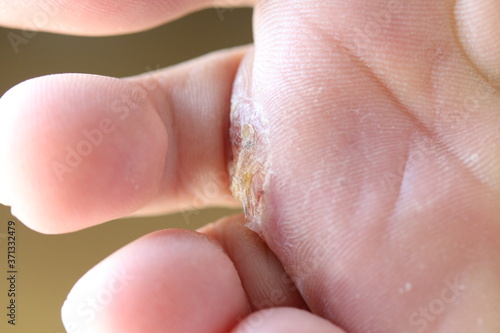重度の水虫に苦しむアレルギーを持つ男性の足と指 