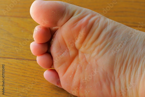 重度の水虫に苦しむアレルギーを持つ男性の足と指
