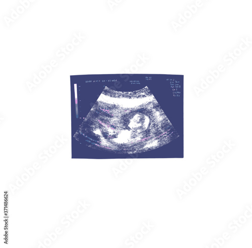 Huge ultrasound picture in mother's womb. Vector illustration in black and white ultrasound Image. Medical and Health of the fetus . Realistic embryo sonography. for cards, postcard design, logo, for 