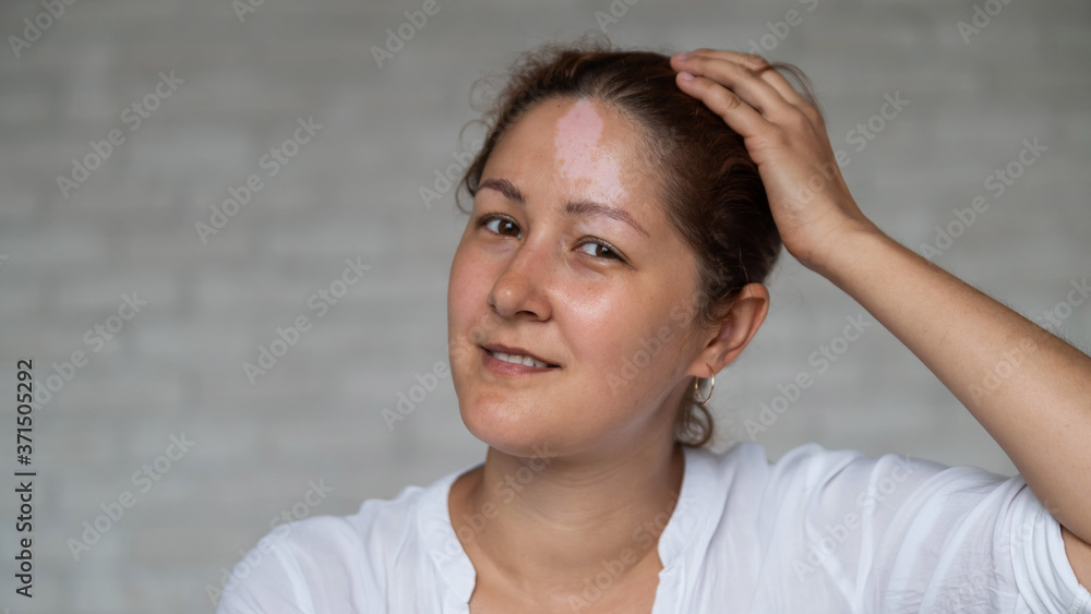 Portrait of a smiling woman with Vitiligo Disease. Portrait of a smiling woman with Vitiligo Disease.