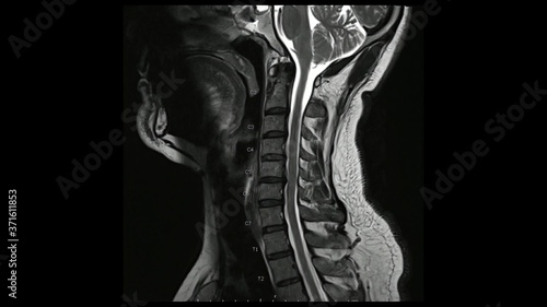 Magnetic Resonance images of Cervical spine sagittal T2-weighted images (MRI Cervical spine) showing Multiple disc disease, more evident at C5-6 disc.