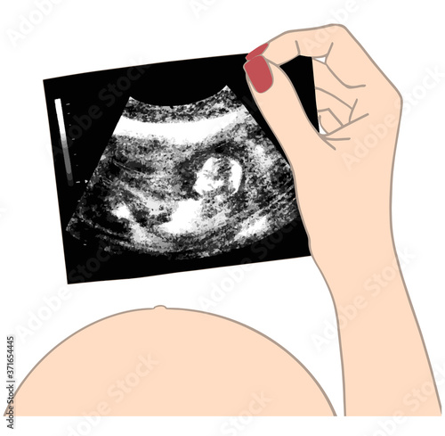 Baby ultrasound picture in hands pregnant girl vector illustration. Fetus silhouette in mother womb, pregnancy diagnostic sonography or ultrasonography concept isolated on white background