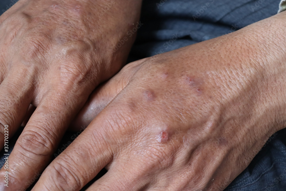 Hand infected. Hand foot and mouth disease HFMD. Allergic Hand infected. Hand foot and mouth disease HFMD. Allergic