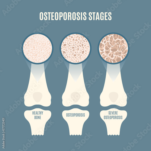 Osteoporosis stages set. Bone mass loss process infographic. Femur cavity tissue close up with different density. Skeletal system disease. Senior osteopathy medical concept. Vector illustration.