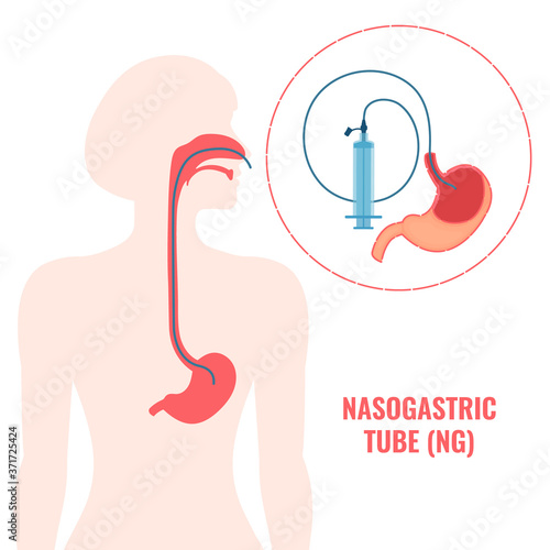Nasogastric tube passed through the nose to stomach. NG with a syringe for feeding and administering medication. Health care and emergency medical concept. Vector illustration.
