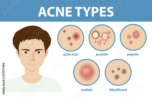 Types of acne on the skin or pimples