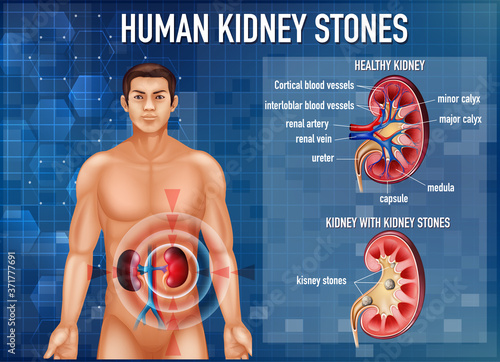 Informative illustration of kidney stones