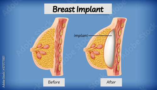 Anatomy of human breast implant