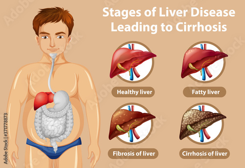 Stages of liver disease leading to Cirrhosis
