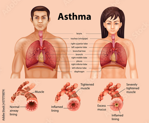 Comparison of healthy lung and Asthmatic lung