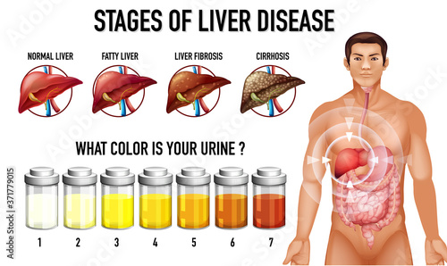Stages of liver disease