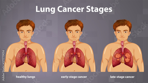 Informative illustration of lung cancer stages