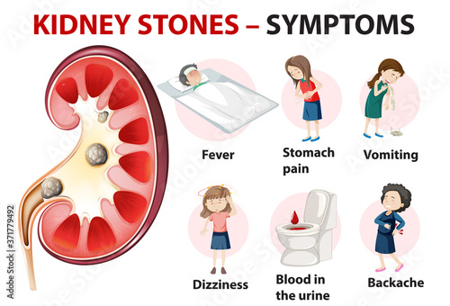 Kidney stones symptoms cartoon style infographic