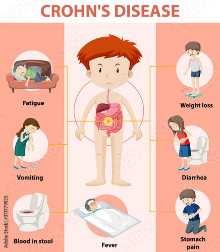 Medical infographic of Crohn's Disease