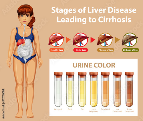 Stages of liver disease leading to Cirrhosis